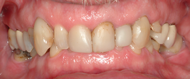 Deep Bite with Front Teeth Tightly Touching