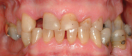 Uneven Bite