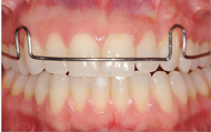 Kois Deprogrammer in the Mouth 1
