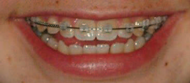 Clear Brackets