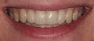 Clear Aligner Trays