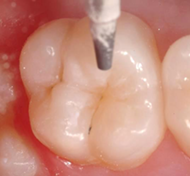 Preparing the teeth for sealants