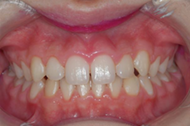 Before flouride treatment