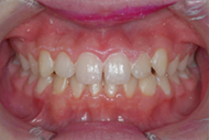 After flouride treatment