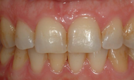Before whitening