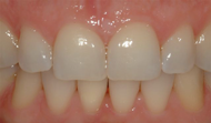 After whitening