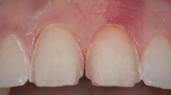 Remove minimal tooth structure