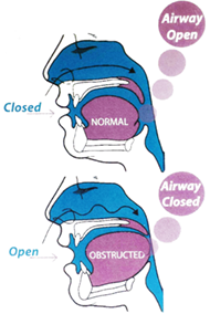 Sleep Disordered Breathing