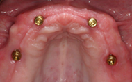 Restores smile and function 3