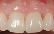 Restored Dental Implant