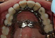 Removable Partial Denture replacing upper teeth 2