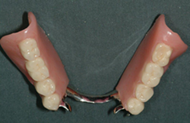 Removable Partial Denture replacing lower teeth 1