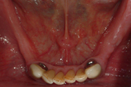 Removable Partial Denture replacing lower teeth 2
