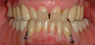 Removable Partial Denture replacing lower teeth 3