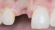 Before Bone Graft