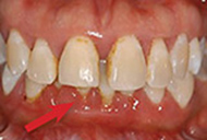 Before non-surgical periodontal therapy