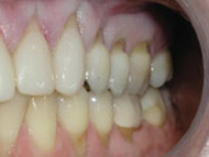 Before Gum Grafting