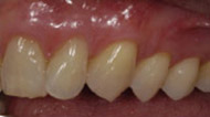 After Gum Grafting