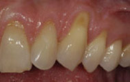Before Gum Grafting