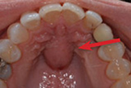 Cyst