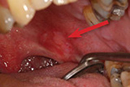 Tumor