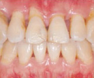Severe Periodontal Disease