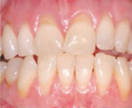 Moderate Periodontal Disease