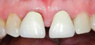 After Surgical Periodontal Therapy