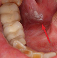 Oral Cancer
