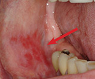 Red Ulcer (Erosive Lichen Planus)