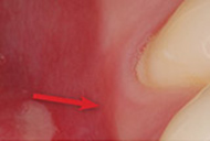 Canker Sore or 'Aphthous Ulcer'