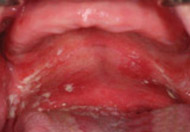 Yeast Infection on the roof of the mouth associated with an upper denture