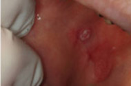Lichen Planus