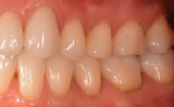 Mild gum line abrasion