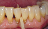 Severe gum line abrasion