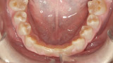 Chewing surface abrasion