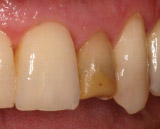 Discolored White Filling