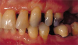 Old Amalgam Stain