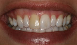 Dark Tooth from Trauma