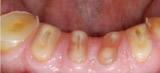 Severe Erosion leading to total destruction of teeth