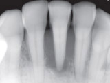'Floating' tooth