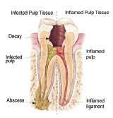 Infected tooth