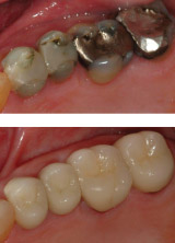 Porcelain fused to metal crowns build back natural tooth appearance and function