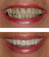 Porcelain crowns build back smile
