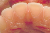 Erosion from Bulimia